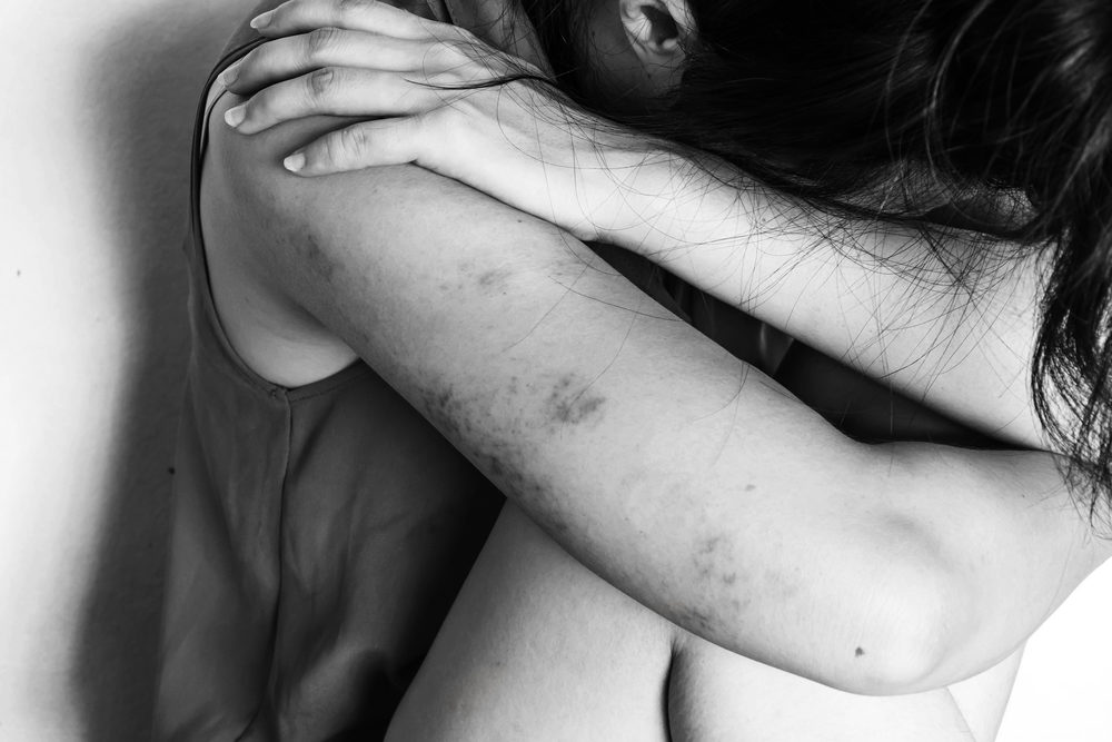 Amended Lawsuit Alleges Fairfax County Police Officers Traded Sex for Protection to Sex Trafficking Ring a woman sitting on ground with arm around knee and lower head, bruises on body