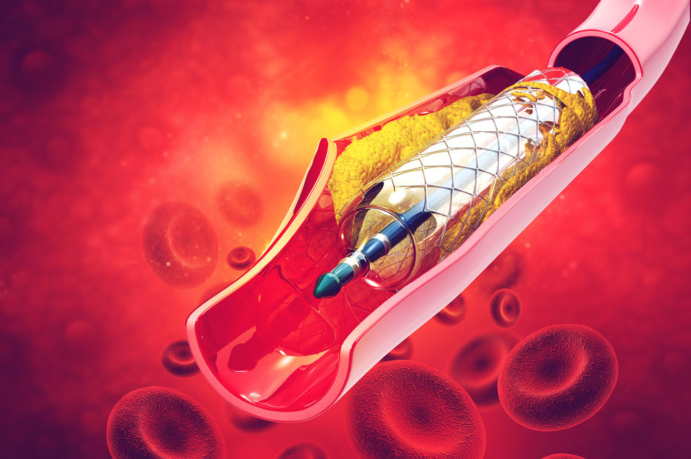 Medtronic Recalls All Valiant Navion Thoracic Graft Systems After Reports of Injuries 3d rendering of stent angioplasty in an artery