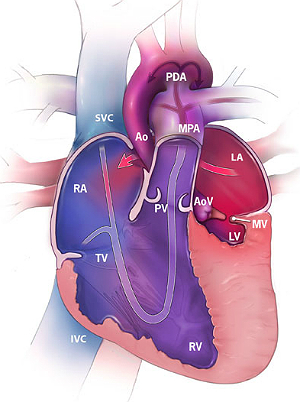 congenital heart defect diagram Hypoplastic Left Heart Syndrome